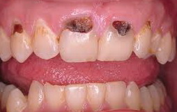 зубные болезни